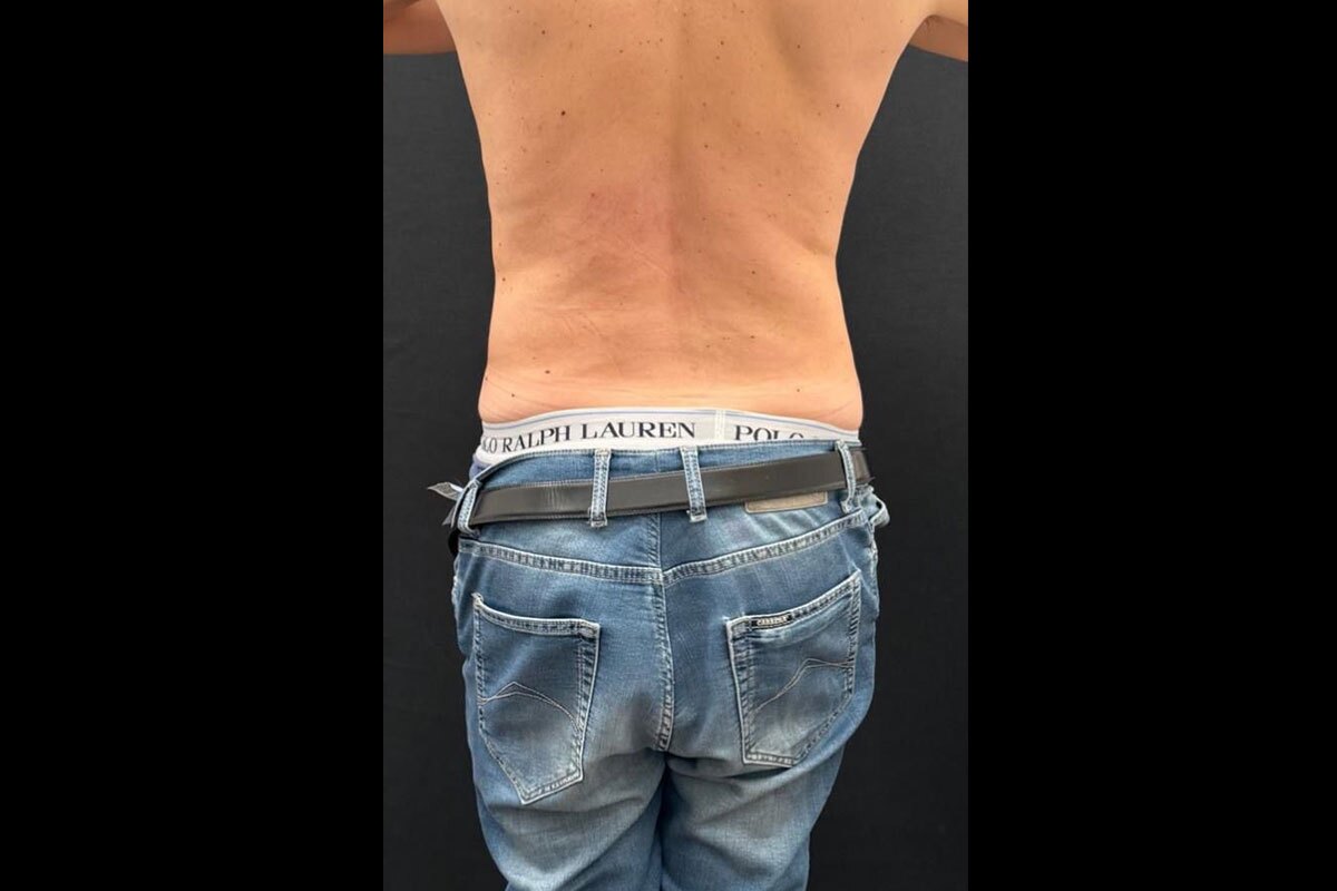 Foto Dopo Liposuzione - Caso 3