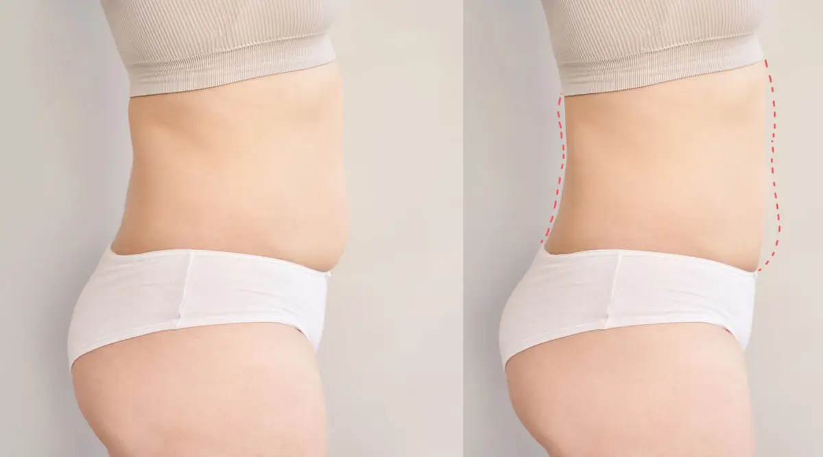 Liposuzione o dieta? Cosa funziona davvero per perdere grasso