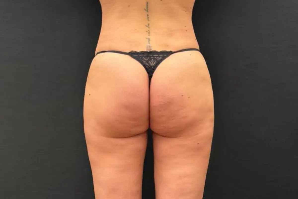 Foto Dopo Liposuzione - Caso 1
