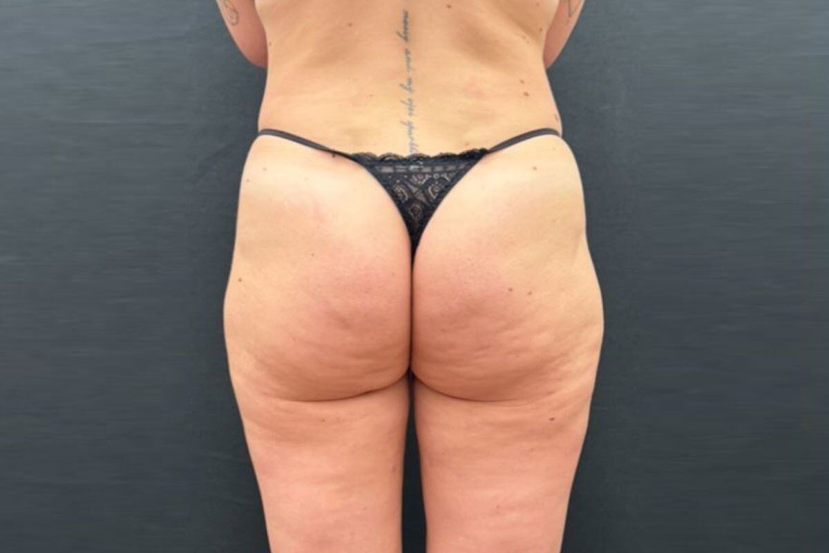 Foto Prima Liposuzione - Caso 1